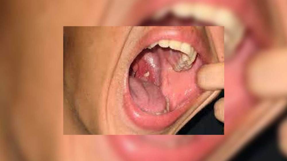 Oral Cancer Cases Gujarat