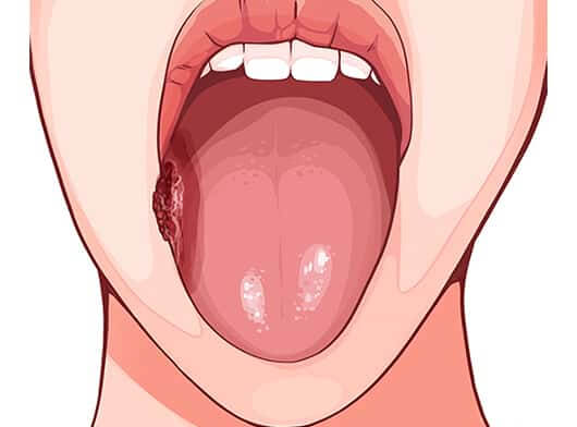 Oral Cancer Cases Gujarat