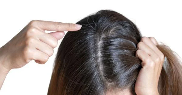 Premature Hair Graying
